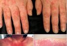 Red, Itchy, and Sweaty Skin are the consequences of having s… See more