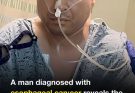 Man diagnosed with esophageal can:cer reveals the first sign he noticed, but doctors ignored